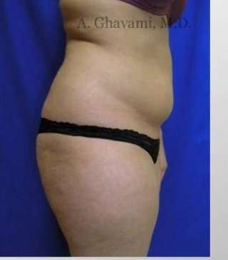Liposuction before and after - before