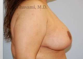 Procedure before and after - after