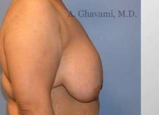 Procedure before and after - before