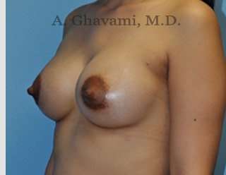 Procedure before and after - after