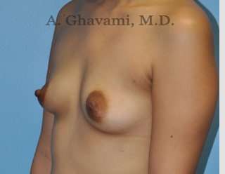 Procedure before and after - before