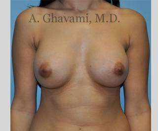 Procedure before and after - after