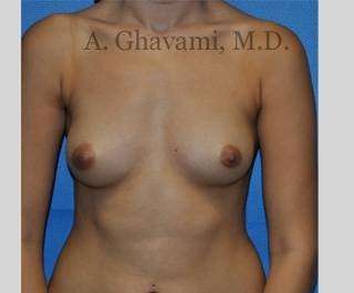Procedure before and after - before