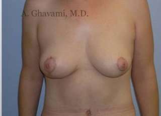 Procedure before and after - after