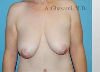 Procedure before and after - before