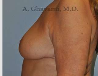 Procedure before and after - after