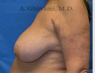 Procedure before and after - before