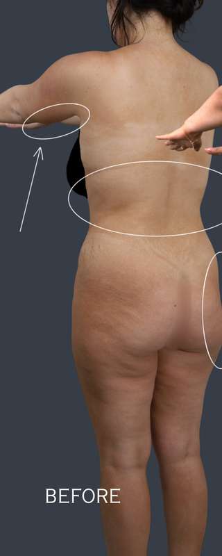 Liposuction before and after - before