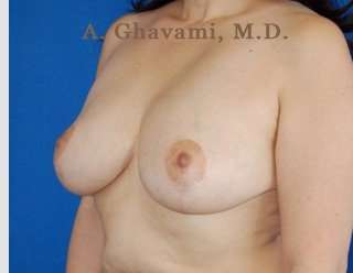 Procedure before and after - after