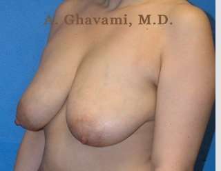 Procedure before and after - before