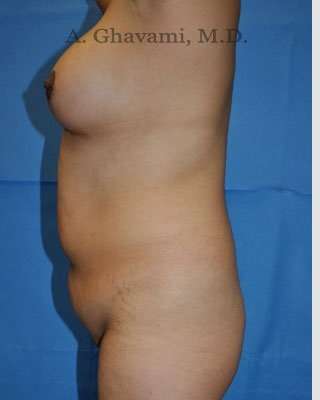 Mommy Makeover before and after - before