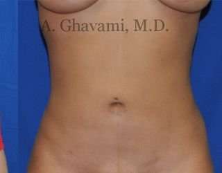 Liposuction before and after - after