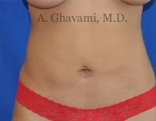 Liposuction before and after - before