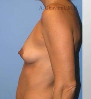 Procedure before and after - before
