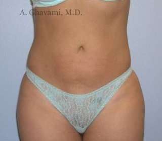 Liposuction before and after - after