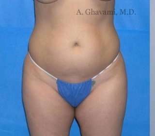 Liposuction before and after - before