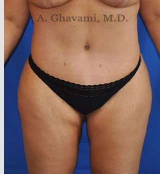 Tummy Tuck before and after - after