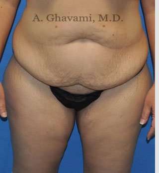 Tummy Tuck before and after - before