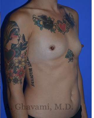 Procedure before and after - before