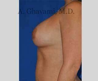 Procedure before and after - after