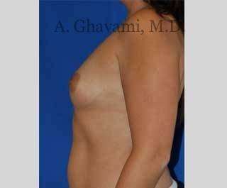 Procedure before and after - before