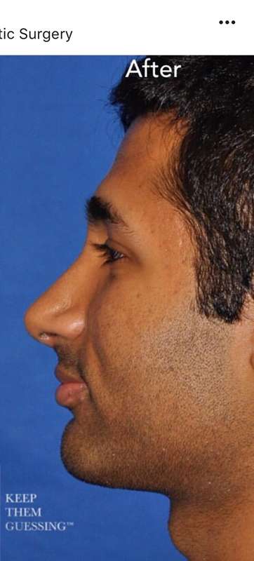 Rhinoplasty before and after - after