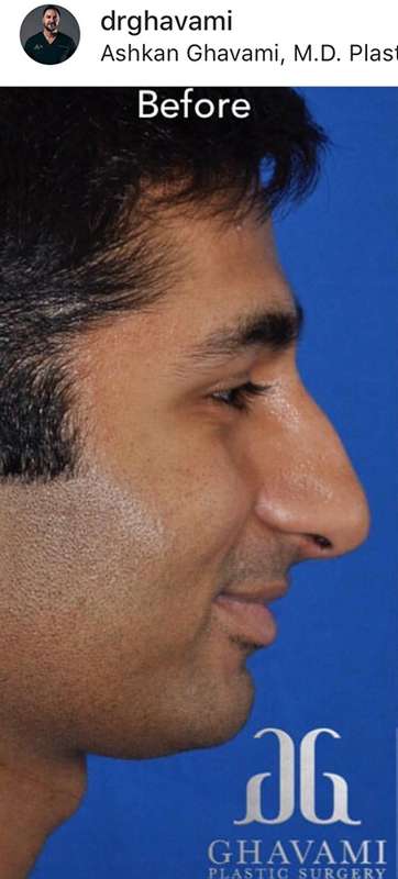 Rhinoplasty before and after - before
