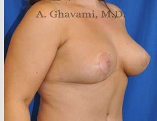 Procedure before and after - after