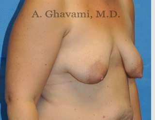 Procedure before and after - before
