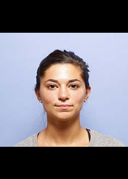 Rhinoplasty before and after - before