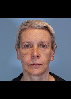 Blepharoplasty before and after - after