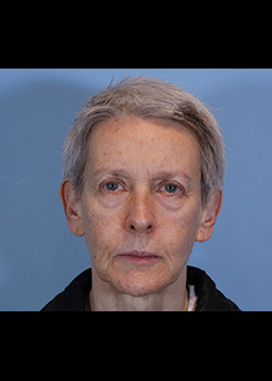 Blepharoplasty before and after - before