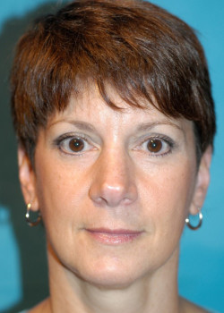 Facelift before and after - after