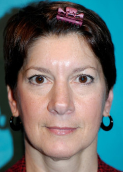 Facelift before and after - before