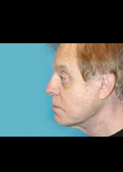 Facelift before and after - after