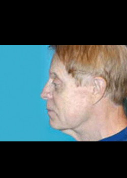 Facelift before and after - before