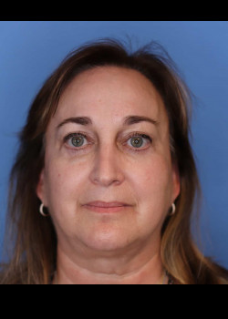 Blepharoplasty after — Dr. Thomas Romo