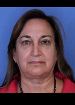 Blepharoplasty before — Dr. Thomas Romo