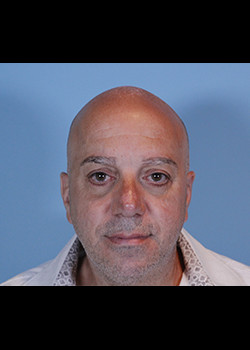 Blepharoplasty after — Dr. Thomas Romo