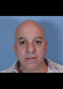 Blepharoplasty before — Dr. Thomas Romo