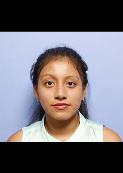 Rhinoplasty before and after - after