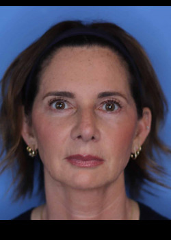 Blepharoplasty before and after - after