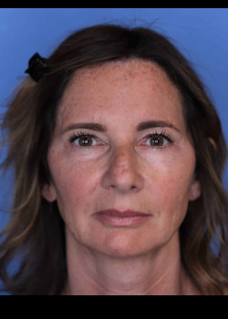 Blepharoplasty before and after - before