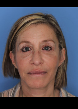 Blepharoplasty before and after - after