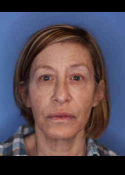 Blepharoplasty before and after - before