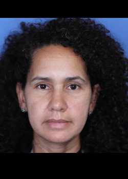 Blepharoplasty before and after - after