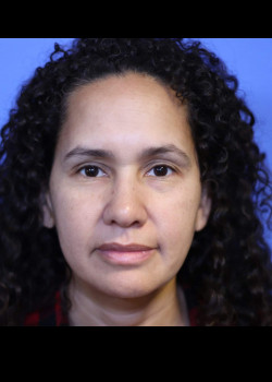Blepharoplasty before and after - before