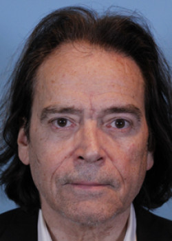 Blepharoplasty after — Dr. Thomas Romo