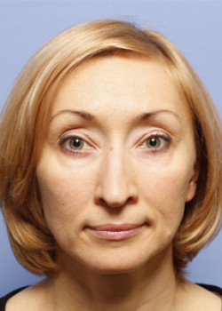 Blepharoplasty after — Dr. Thomas Romo