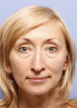 Blepharoplasty before — Dr. Thomas Romo